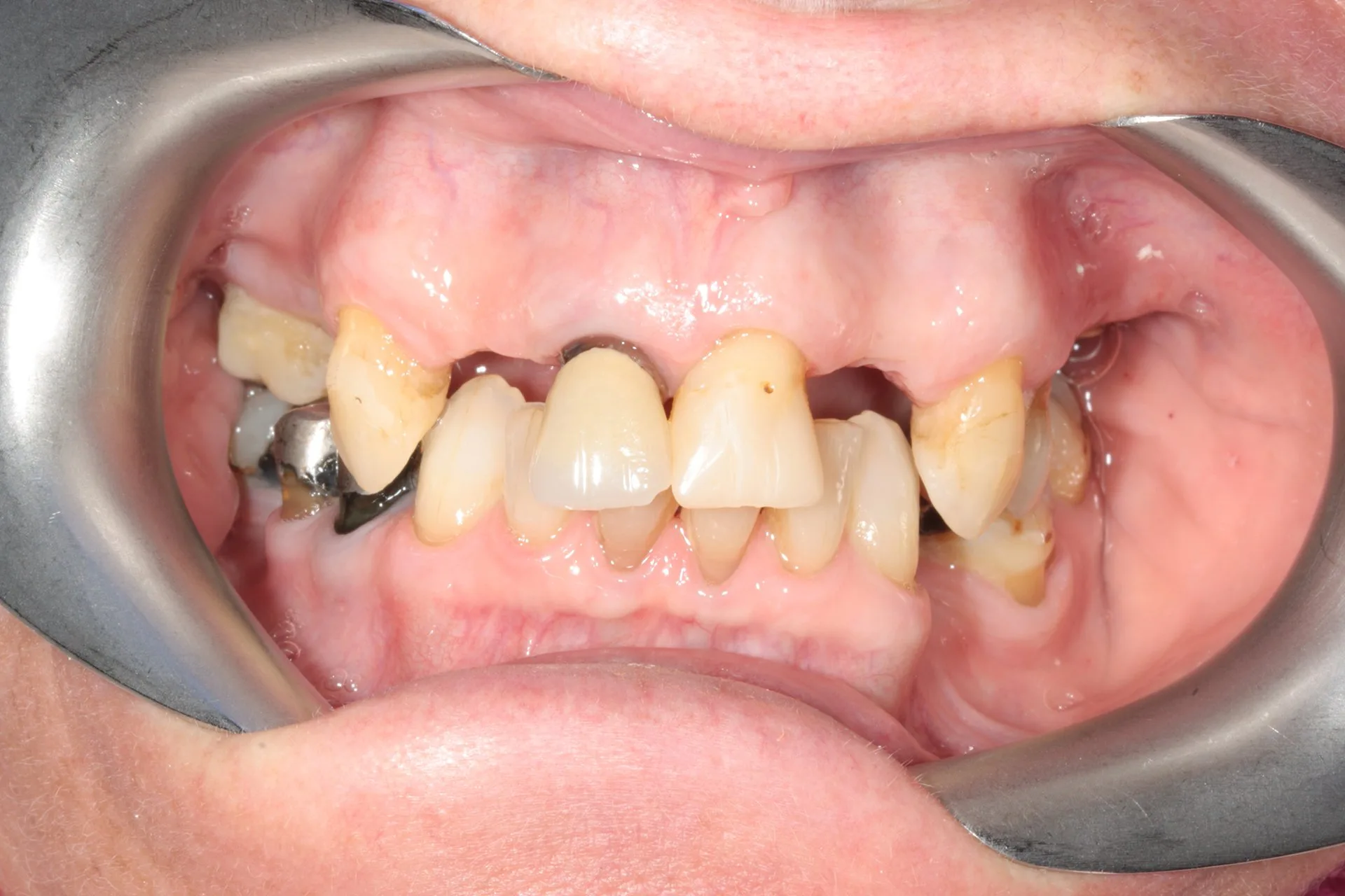 Before dental implant reconstruction at Index Medica