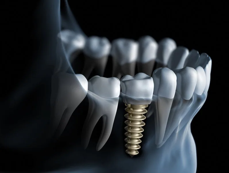 Dental implants treatment in Kraków Poland