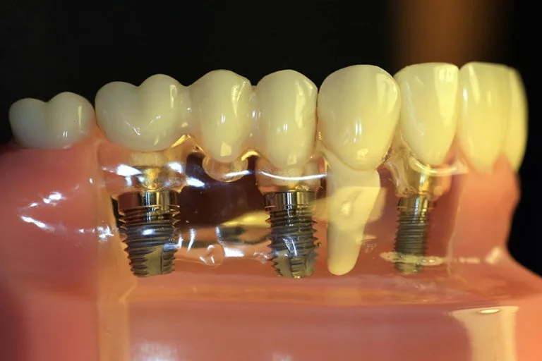 Dental implant model showing implant-supported teeth restoration in Kraków dental clinic