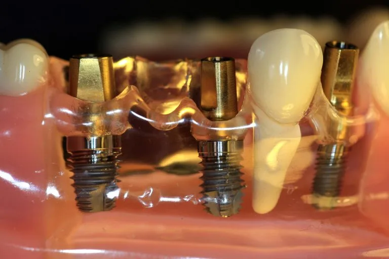 Detailed dental implant system with implant crown and prosthetic restoration