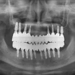 Panoramic dental X-ray showing full arch implant reconstruction planning