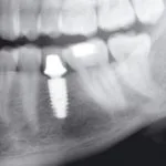 Dental X-ray showing single dental implant placement planning